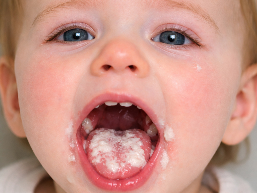 dieťa s kvasinkovou infekciou